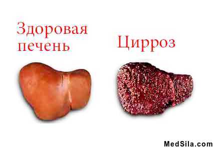 нормальная печень и печень, пораженная циррозом